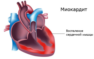 Миокардит: причины, диагностика, симптомы, лечение