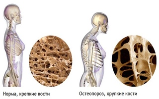 Остеопороз: симптомы и лечение у женщин после 50 лет (в менопаузальном периоде)