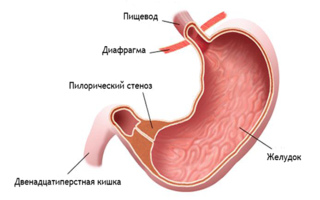 Стеноз привратника